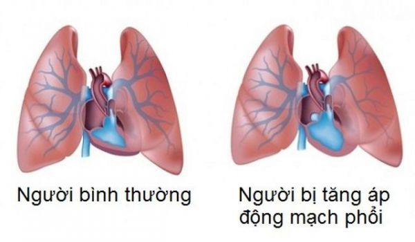 Bệnh tăng huyết áp phổi - Triệu chứng, nguyên nhân và cách điều trị