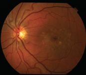 Bệnh stargardt - Triệu chứng, nguyên nhân và cách điều trị