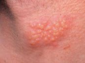 Bệnh sùi mào gà - Triệu chứng, nguyên nhân và cách điều trị