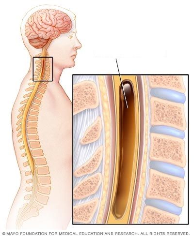 Hội chứng rỗng tuỷ sống - Triệu chứng, nguyên nhân và cách điều trị