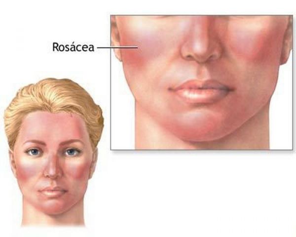 Hội chứng rosacea - Triệu chứng, nguyên nhân và cách điều trị
