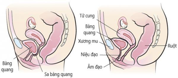 Bệnh sa bàng quang - Triệu chứng, nguyên nhân và cách điều trị