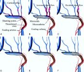 Bệnh rò động tĩnh mạch - Triệu chứng, nguyên nhân và cách điều trị