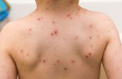 Bệnh sởi - Triệu chứng, nguyên nhân và cách điều trị