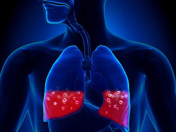 Hội chứng phù phổi - Triệu chứng, nguyên nhân và cách điều trị