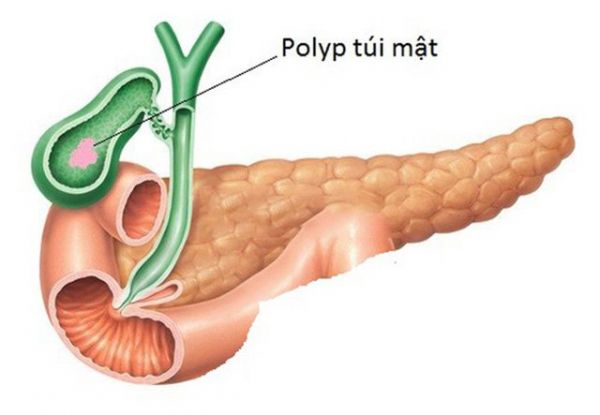 Hội chứng polyp túi mật - Triệu chứng, nguyên nhân và cách điều trị