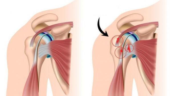 Bệnh rách cơ quay khớp vai - Triệu chứng, nguyên nhân và cách điều trị