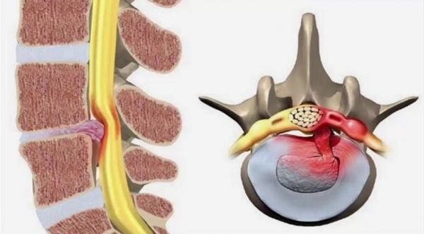 Bệnh rách đĩa đệm - Triệu chứng, nguyên nhân và cách điều trị