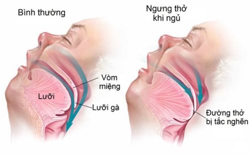 Bệnh rối loạn ngưng thở khi ngủ - Triệu chứng, nguyên nhân và cách điều trị
