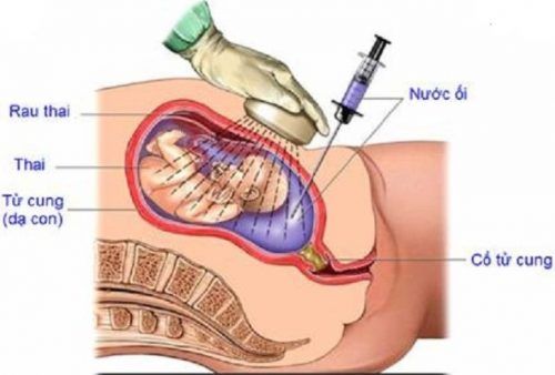 Sinh thiết gai nhau - Quy trình thực hiện và những lưu ý cần biết