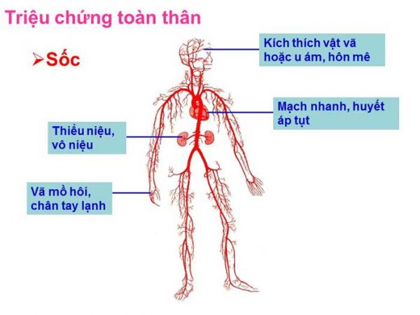 Bệnh sốc giảm thể tích - Triệu chứng, nguyên nhân và cách điều trị