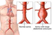 Bệnh phình động mạch chủ bụng - Triệu chứng, nguyên nhân và cách điều trị