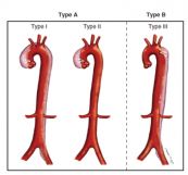 Bệnh phình và tách động mạch chủ - Triệu chứng, nguyên nhân và cách điều trị