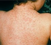 Bệnh rubella - Triệu chứng, nguyên nhân và cách điều trị