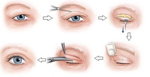 Phẫu thuật sa mi mắt - Quy trình thực hiện và những lưu ý cần biết