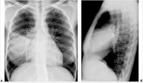 Hội chứng phổi đông đặc - Triệu chứng, nguyên nhân và cách điều trị