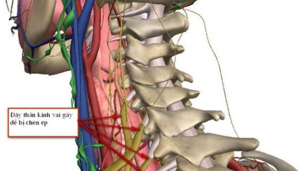 Bệnh rễ thần kinh cổ - Triệu chứng, nguyên nhân và cách điều trị