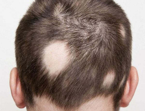 Hội chứng rụng tóc từng mảng - Triệu chứng, nguyên nhân và cách điều trị