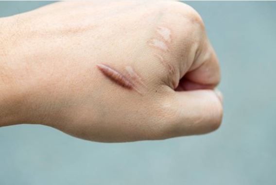 Sẹo lồi - Triệu chứng, nguyên nhân và cách điều trị