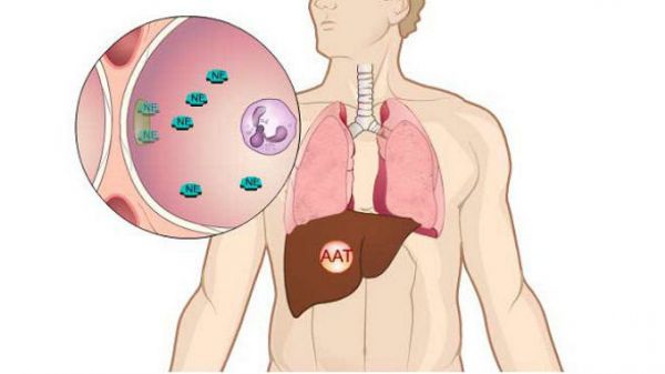 Bệnh thiếu men alpha-1 antitrypsin - Triệu chứng, nguyên nhân và cách điều trị