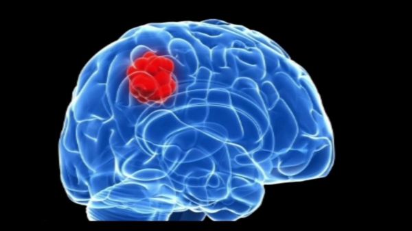 Bệnh u não - Triệu chứng, nguyên nhân và cách điều trị