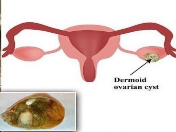 Bệnh u quái - Triệu chứng, nguyên nhân và cách điều trị