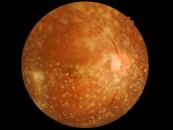 Những rối loạn của thể thủy tinh - Triệu chứng, nguyên nhân và cách điều trị