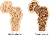 Bệnh nhuyễn xương - Triệu chứng, nguyên nhân và cách điều trị
