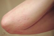 Hội chứng nổi mề đay - Triệu chứng, nguyên nhân và cách điều trị