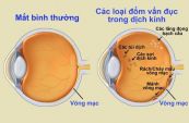 Bệnh vẩn đục dịch kính - Triệu chứng, nguyên nhân và cách điều trị