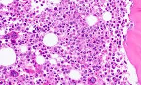 Bệnh niemann-Pick - Triệu chứng, nguyên nhân và cách điều trị