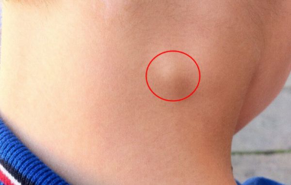 Hội chứng nổi hạch (sưng hạch) - Triệu chứng, nguyên nhân và cách điều trị