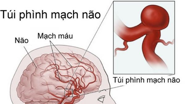 Phẫu thuật phình động mạch não - Quy trình thực hiện và những lưu ý cần biết