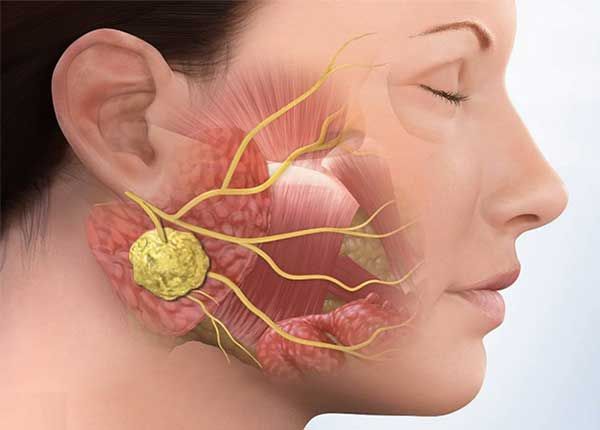 Bệnh u tuyến nước bọt - Triệu chứng, nguyên nhân và cách điều trị