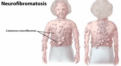 Bệnh u xơ thần kinh loại 2 - Triệu chứng, nguyên nhân và cách điều trị