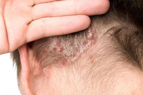 Bệnh vảy nến da đầu - Triệu chứng, nguyên nhân và cách điều trị