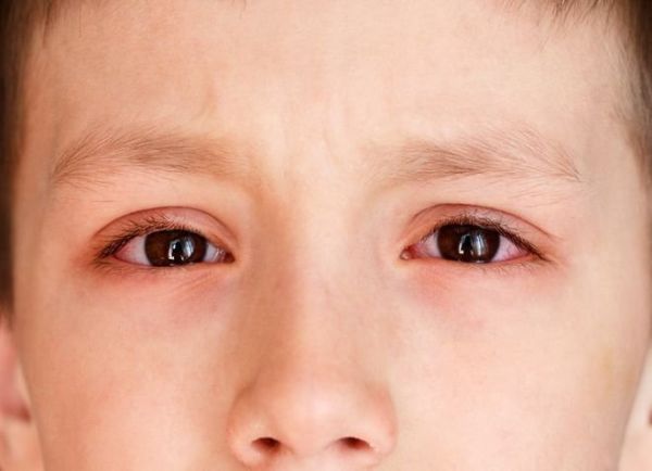 Bệnh nhiễm trùng mắt - Triệu chứng, nguyên nhân và cách điều trị
