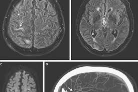 Bệnh nhiễm trùng não - Triệu chứng, nguyên nhân và cách điều trị