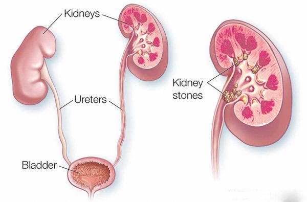Nhiễm trùng thận - Triệu chứng, nguyên nhân và cách điều trị