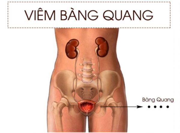 Bệnh viêm bàng quang - Triệu chứng, nguyên nhân và cách điều trị