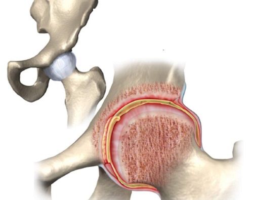 Bệnh viêm bao hoạt dịch khớp háng - Triệu chứng, nguyên nhân và cách điều trị