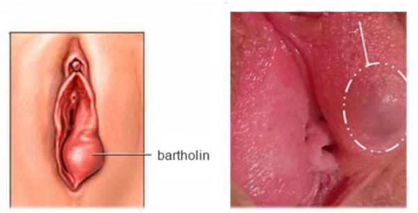 Bệnh nang tuyến Bartholin - Triệu chứng, nguyên nhân và cách điều trị