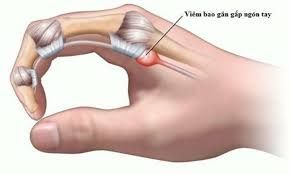 Hội chứng ngón tay cò súng - Triệu chứng, nguyên nhân và cách điều trị