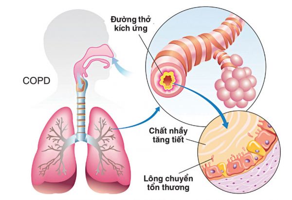 Bệnh phổi tắc nghẽn mạn tính - Triệu chứng, nguyên nhân và cách điều trị
