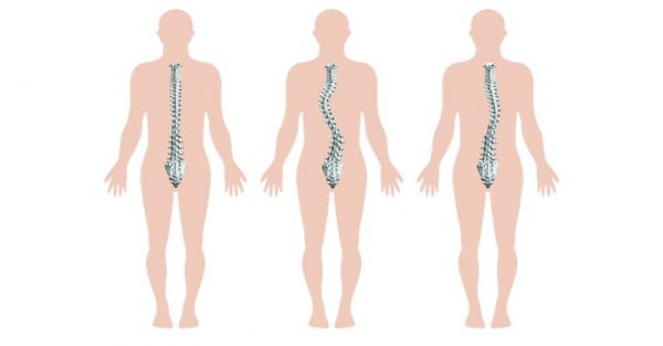 Bệnh rối loạn cong cột sống - Triệu chứng, nguyên nhân và cách điều trị
