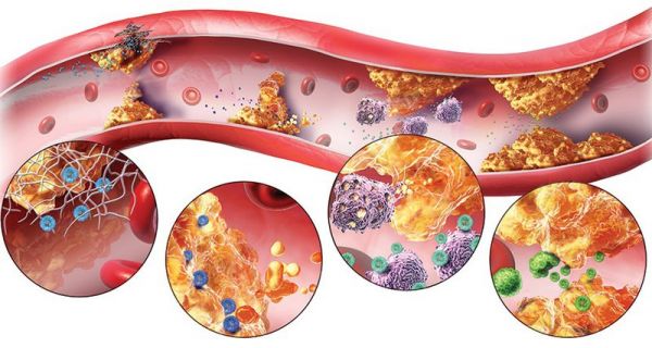 Bệnh rối loạn mỡ máu - Triệu chứng, nguyên nhân và cách điều trị