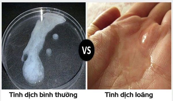 Bệnh tinh dịch loãng - Triệu chứng, nguyên nhân và cách điều trị