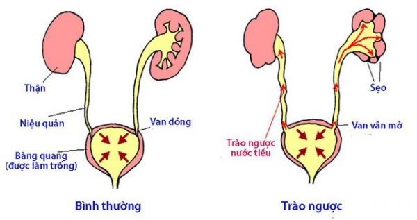Bệnh trào ngược bàng quang niệu quản - Triệu chứng, nguyên nhân và cách điều trị