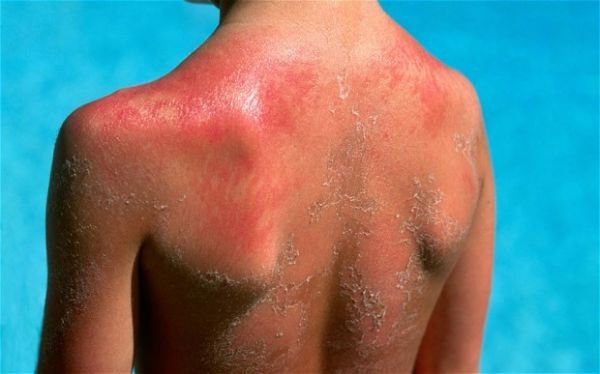 Bệnh viêm da do ánh nắng - Triệu chứng, nguyên nhân và cách điều trị