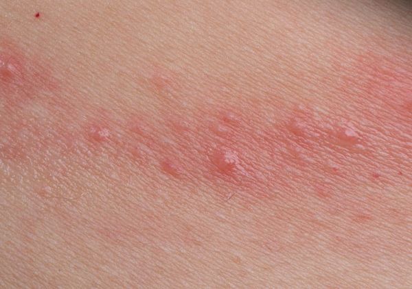 Bệnh viêm da tiếp xúc - Triệu chứng, chẩn đoán và cách điều trị